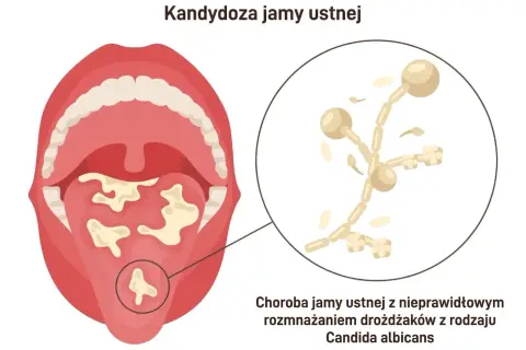 Ilustracja przedstawia jamę ustną z białymi nalotami na języku i podniebieniu, objawy grzybicy jamy ustnej. Powiększony fragment ukazuje drożdżaki Candida albicans.