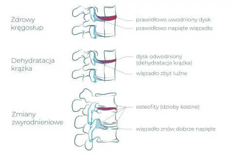 Ilustracja pokazuje postęp zwyrodnienia kręgosłupa lędźwiowego: od zdrowego dysku, przez jego odwodnienie, po zmiany zwyrodnieniowe z osteofitami.