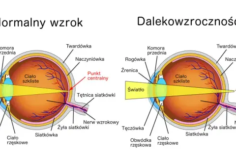 Porównanie oka z normalnym wzrokiem i dalekowzrocznością. Światło skupia się za siatkówką przy dalekowzroczności.