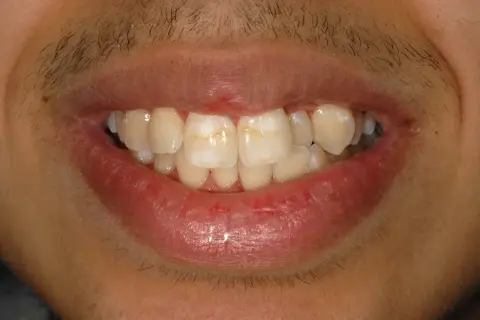 Denti con macchie bianche, possibili segni di carie iniziale.