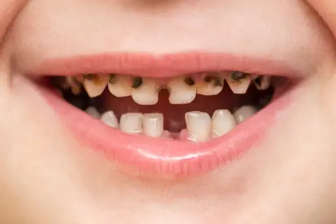 Boca de niño con dientes muy dañados por caries, algunos rotos y oscuros. Es importante recordar que las caries se contagian.