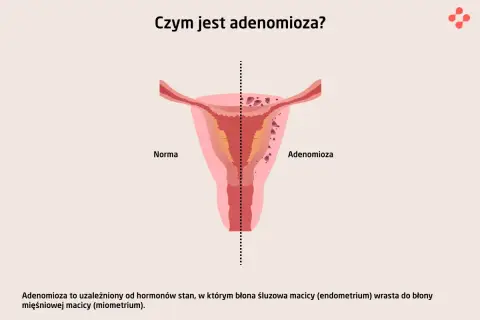 Ilustracja porównuje zdrową macicę (Norma) z macicą dotkniętą **adenomiozą**, gdzie tkanka endometrium wrasta w mięśniówkę.