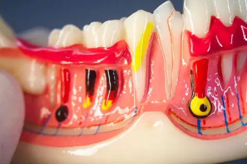 Modello anatomico di denti e gengive, con evidenziati nervi e vasi sanguigni. Si nota il colletto dentale e la struttura ossea.