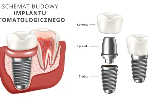 Schemat budowy implantu stomatologicznego. Dowiedz się, ile kosztuje implant zęba, poznając jego elementy: śrubę, łącznik i koronę.