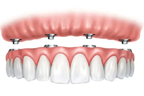 Arcata dentale superiore con impianti dentali. La protesi superiore si aggancia a quattro pilastri metallici.