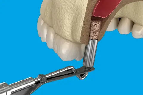 Zabieg augmentacji kości: implant stomatologiczny umieszczany w wyrostku zębodołowym, podnoszenie dna zatoki szczękowej.