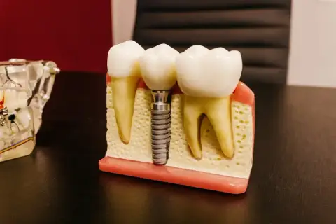 Model szczęki z zębami i mikroimplantem ortodontycznym. Pokazuje, jak implant zastępuje korzeń zęba.