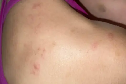 Piel con marcas rojas y elevadas, indicando posible acne en la espalda.