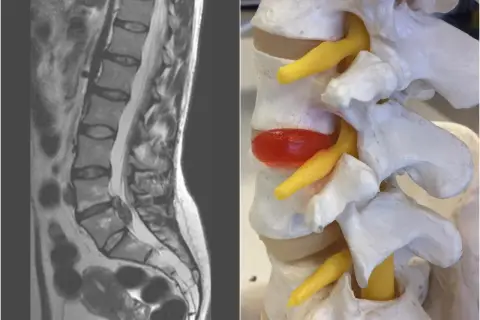Obraz porównuje rezonans magnetyczny kręgosłupa z modelem anatomicznym, ukazując bulging krążka międzykręgowego uciskającego nerw.