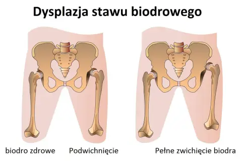 Ilustracja porównuje zdrowe biodro z dysplazją stawu biodrowego u dorosłych, pokazując podwichnięcie i pełne zwichnięcie.