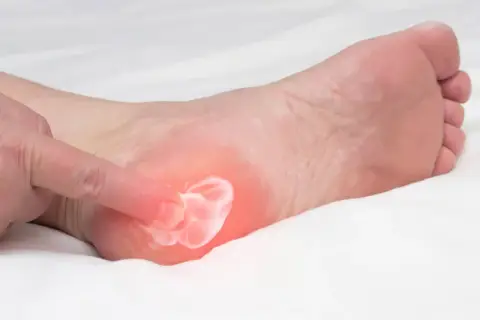 Application d'une crème pour soulager la douleur d'une aponévrosite plantaire. Un doigt masse la zone rouge sur le talon.