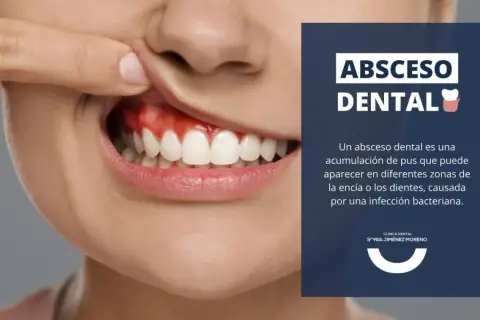 Primer plano de una boca mostrando encías rojas e inflamadas, indicativo de un absceso en la encía. Texto informativo sobre abscesos dentales.