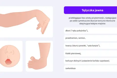 Tężyczka nerwicowa objawy: dłoń jak u położnika, skurcz twarzy, "usta karpia", drętwienie kończyn.