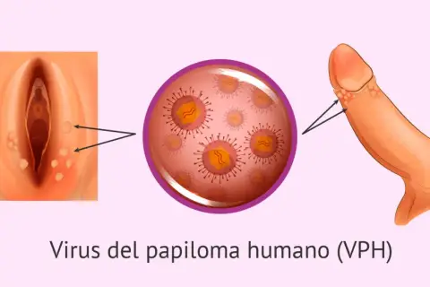 Síntomas del papiloma humano en mujeres: lo que debes saber para actuar
