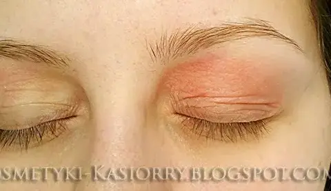 Alergia na oprawki okularowe: objawy, przyczyny i jak sobie radzić
