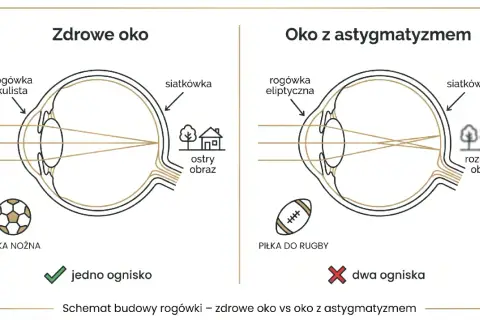 Zdrowe oko z kulistą rogówką skupia światło w jednym punkcie, dając ostry obraz. Oko z astygmatyzmem ma eliptyczną rogówkę, co powoduje rozmyty obraz.