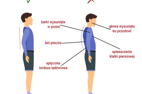 Ilustracja pokazuje prawidłową i nieprawidłową postawę. Nieprawidłowa postawa, z wysuniętymi barkami i głową, spłaszczoną klatką piersiową i płaską lordozą lędźwiową, może być objawem zesztywniającego zapalenia stawów kręgosłupa.