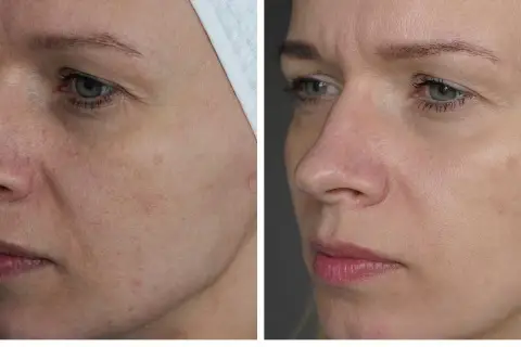 Przed i po zabiegu laserem frakcyjnym. Widoczna poprawa tekstury skóry, redukcja przebarwień i naczynek. Laser frakcyjny gojenie przyspiesza regenerację.