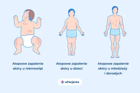 Ilustracja pokazuje atopowe zapalenie skóry u niemowląt, dzieci i dorosłych, uwidaczniając typowe objawy na skórze w różnych grupach wiekowych.