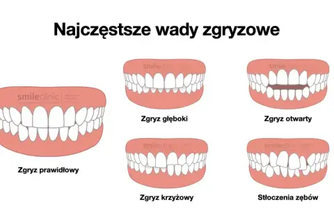 Ilustracja pokazuje różne wady zgryzu, w tym zgryz głęboki, otwarty, krzyżowy i stłoczenia zębów. Wady te mogą dotyczyć również tyłozgryzu u dziecka.