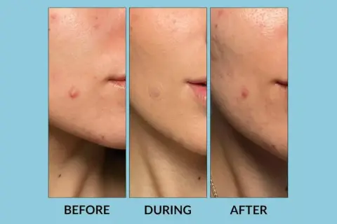 Tres imágenes de un rostro mostrando la evolución de un grano. Antes, durante con un parche de hidrocoloide, y después, con el grano reducido.