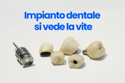 Componenti di un impianto dentale, inclusa una vite, su sfondo bianco.