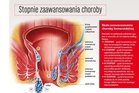 Do jakiego lekarza z hemoroidami? Ważne informacje, które musisz znać