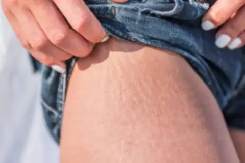 Piel con estrías, un detalle común que muchas mujeres buscan cómo quitar estrías.