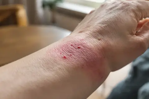 Poignet rouge et irrité, avec des petites cloques, comme une cicatrice qui brûle.
