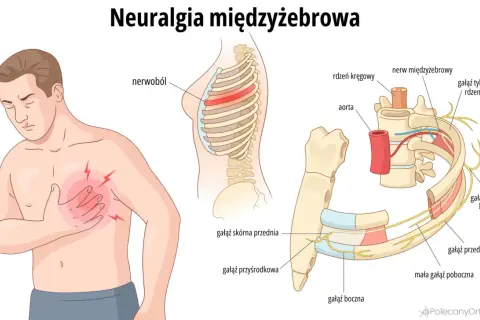 Mężczyzna odczuwa ból mostka, ilustracja pokazuje unerwienie żeber i kręgosłupa, wyjaśniając neuralgię międzyżebrową.