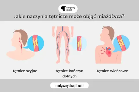 Miażdżyca objawy: zwężone tętnice szyjne, kończyn dolnych i wieńcowe. Ilustracja pokazuje, jak choroba wpływa na naczynia krwionośne.