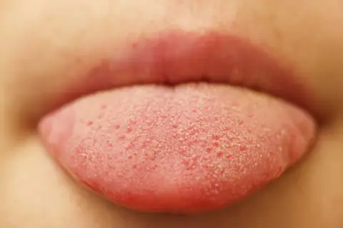 Lingua rossa con piccole bollicine, forse un bambino ha assaggiato qualcosa di nuovo e frizzante!