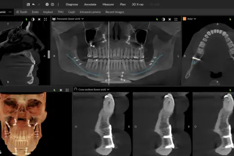 CBCT co to? Obraz przedstawia skany 3D szczęki i żuchwy z implantami, pokazujące szczegółową anatomię kości i zębów.
