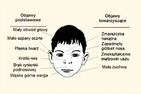 Ilustracja przedstawia twarz dziecka z zaznaczonymi objawami, które mogą wskazywać na zespół FAS.