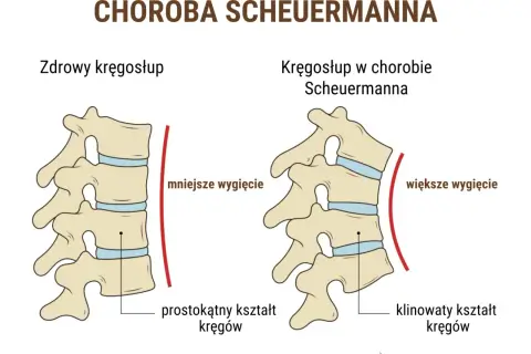 Porównanie zdrowego kręgosłupa z kręgosłupem w chorobie Scheuermanna. Widoczne klinowate kręgi i większe wygięcie.