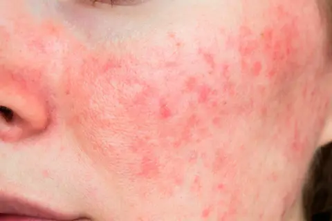 Rostro con enrojecimiento y pequeños bultos, indicativo de rosacea leve.