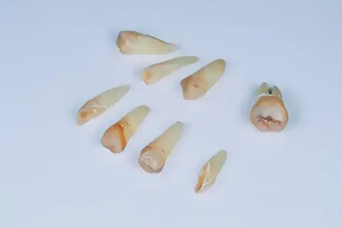 Ból po wyrwaniu ósemki: Jak długo? Kiedy do dentysty?