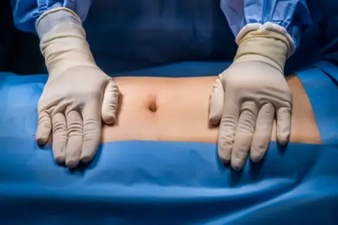 Ręce w rękawiczkach chirurgicznych badają brzuch pacjenta, przygotowując się do operacji przepukliny brzusznej.