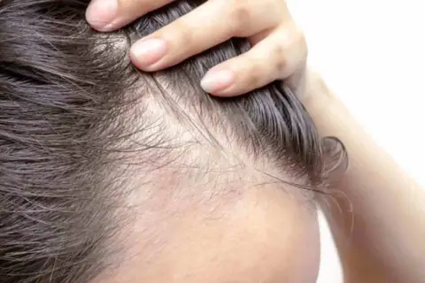 Dita che sfiorano la cute, evidenziando diradamento e sottili capelli. Un segno visibile di alopecia da stress.