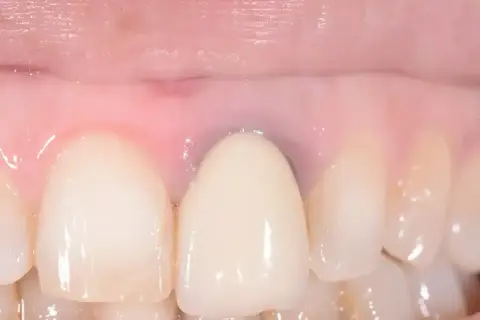 Dettaglio di denti con una corona e gengive rosa, con alcune aree che mostrano sfumature di gengive nere.