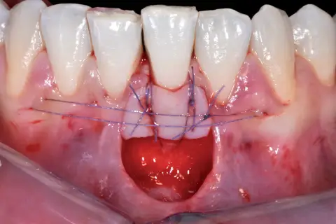 Primo piano di un innesto gengivale con suture viola che fissano il tessuto.