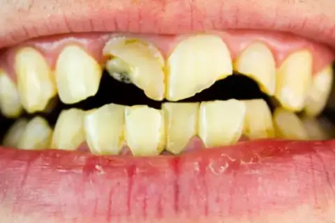Dientes amarillentos y rotos, con caries visibles. Un triste reflejo de los dientes de drogadicto, que muestran el devastador efecto de las adicciones en la salud bucal.