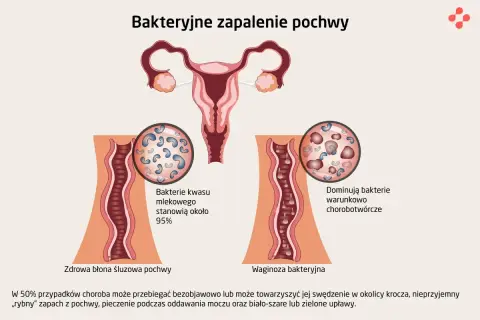 Ilustracja porównuje zdrową florę pochwy z dominacją bakterii kwasu mlekowego do waginozy bakteryjnej, gdzie przeważają bakterie chorobotwórcze.