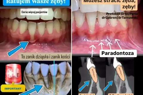 Paradontoza: przed i po leczeniu. Widoczne zaniki dziąseł i kości, a także efekty odbudowy.