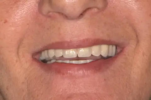 Un sorriso smagliante, ma attenzione: il tè macchia i denti.