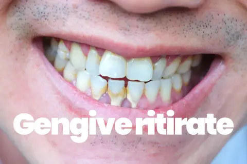 Denti con tartaro e gengive ritirate. Scopri le vitamine per gengive ritirate e migliora la tua igiene orale.