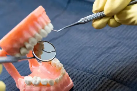 Model szczęki z widoczną próchnicą z boku zęba, badany lusterkiem dentystycznym.