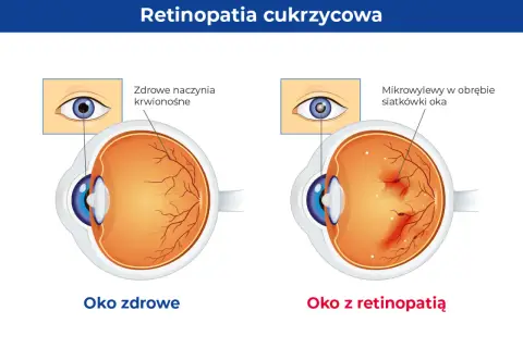 Porównanie zdrowego oka z naczyniami krwionośnymi siatkówki i oka z retinopatią cukrzycową, gdzie widoczne są mikrowylewy.