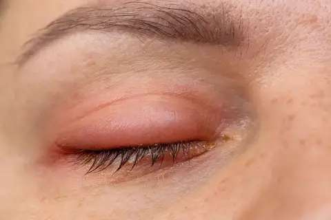 Ojo con un parpado hinchado y enrojecido, con restos de secreción amarilla en las pestañas.