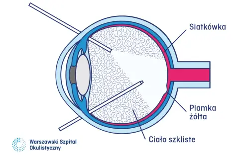 Schemat oka z zaznaczonym ciałem szklistym, siatkówką i plamką żółtą. Widać narzędzia do zabiegu witrektomii.
